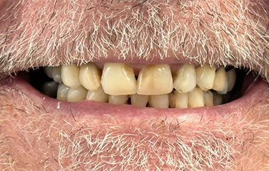 Donald Rebello Before Close-up of Donald's teeth before Dr. Cameron began his dental work.