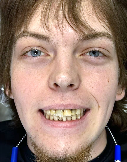 Hayden-Boudreaus-Before-Face-adj Full-face picture of Hayden before Dr. Cameron began his dental work.
