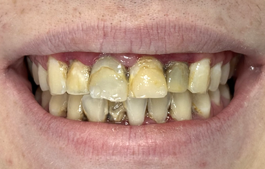 Hayden Boudreaus Before Close-up of Hayden's teeth before Dr. Cameron began his dental work.