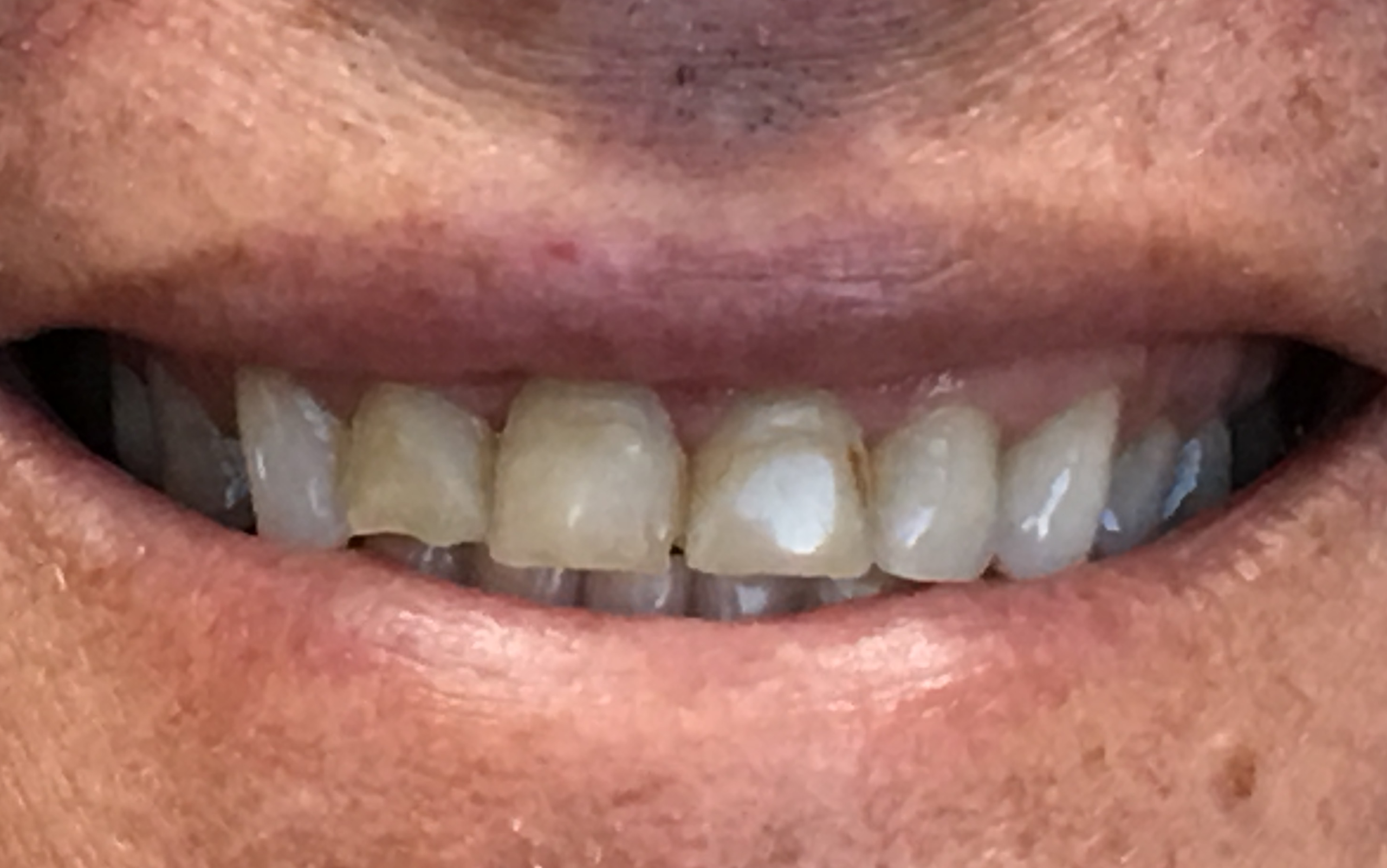 KEN CAMERON Before Very Close-up picture of Ken's teeth before Dr. Cameron began his dental work.