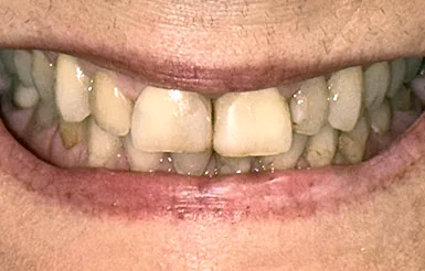 Linda-Ouimet-Before-adj Close-up of Linda's teeth before Dr. Cameron began working on her teeth
