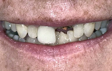 Melinda-Thomas-Before-adj Close-up of Melinda's teeth before Dr. Cameron began working on her teeth