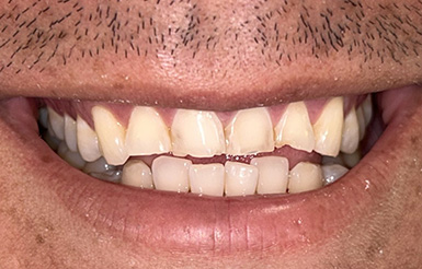 franco-before